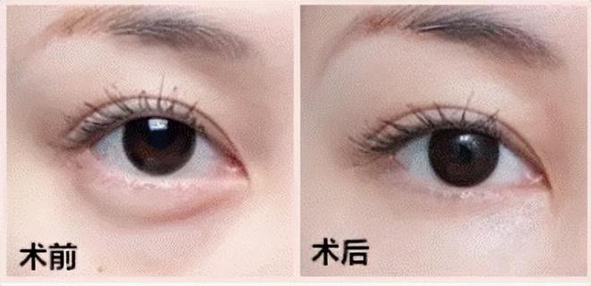 最新去眼袋手术，重塑眼部魅力，重塑青春光彩