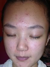 最新去粉刺方法，重拾肌肤光彩的秘诀攻略